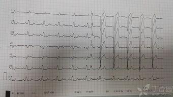 心电图吃瓜,揭秘瓜类食品的心脏保健功效